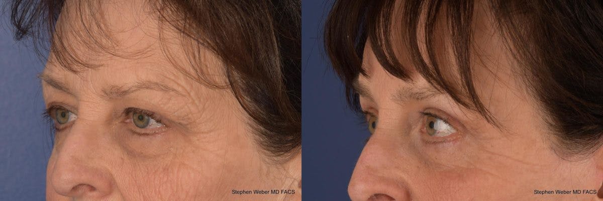 Brow Lift Before & After Gallery - Patient 233864 - Image 3