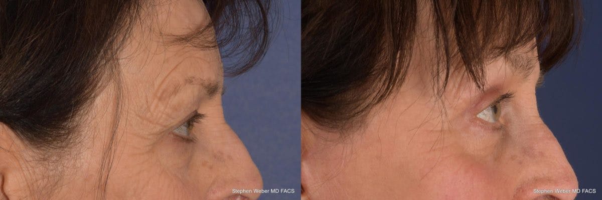Brow Lift Before & After Gallery - Patient 233864 - Image 4