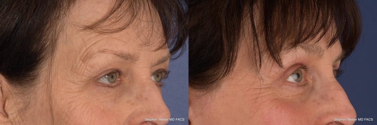 Brow Lift Before & After Gallery - Patient 233864 - Image 5