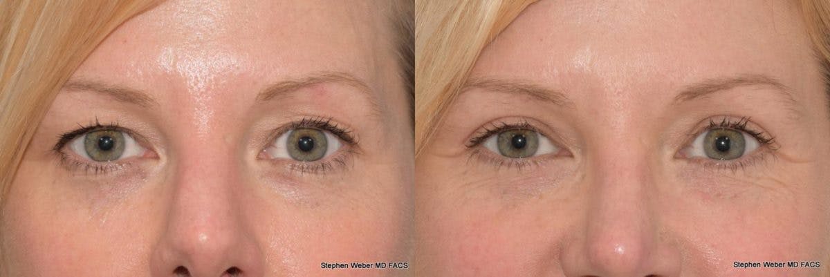 Blepharoplasty Before & After Gallery - Patient 185974 - Image 1