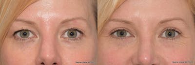 Blepharoplasty Before & After Gallery - Patient 185974 - Image 1