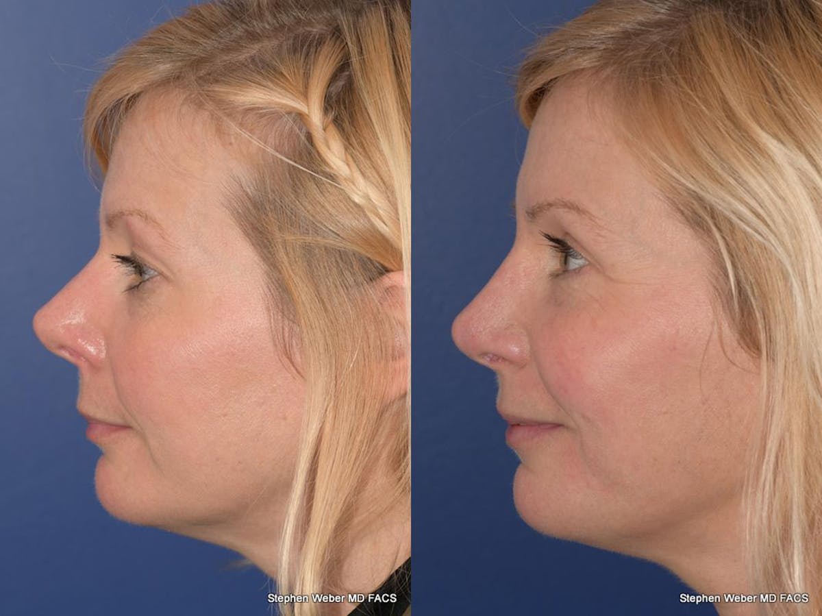 Blepharoplasty Before & After Gallery - Patient 185974 - Image 2