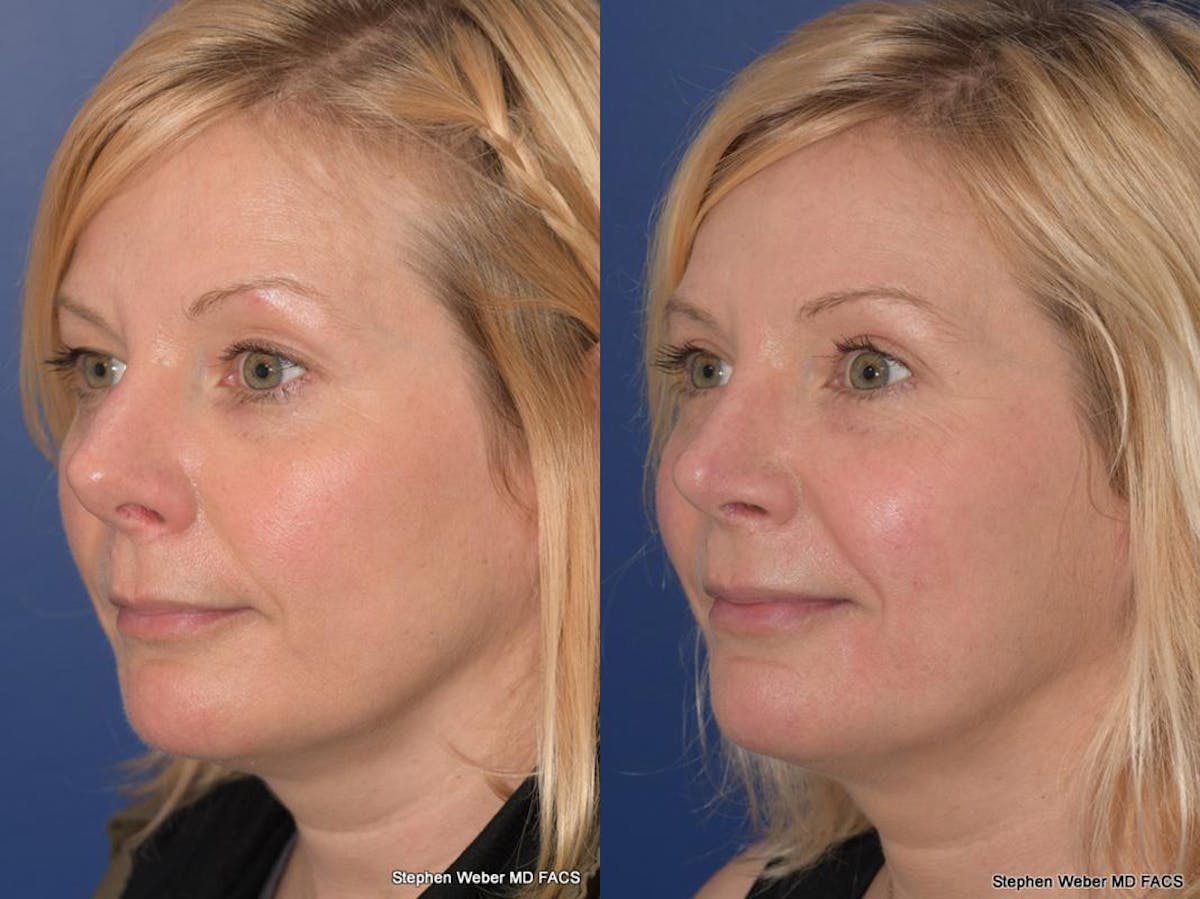 Blepharoplasty Before & After Gallery - Patient 185974 - Image 3