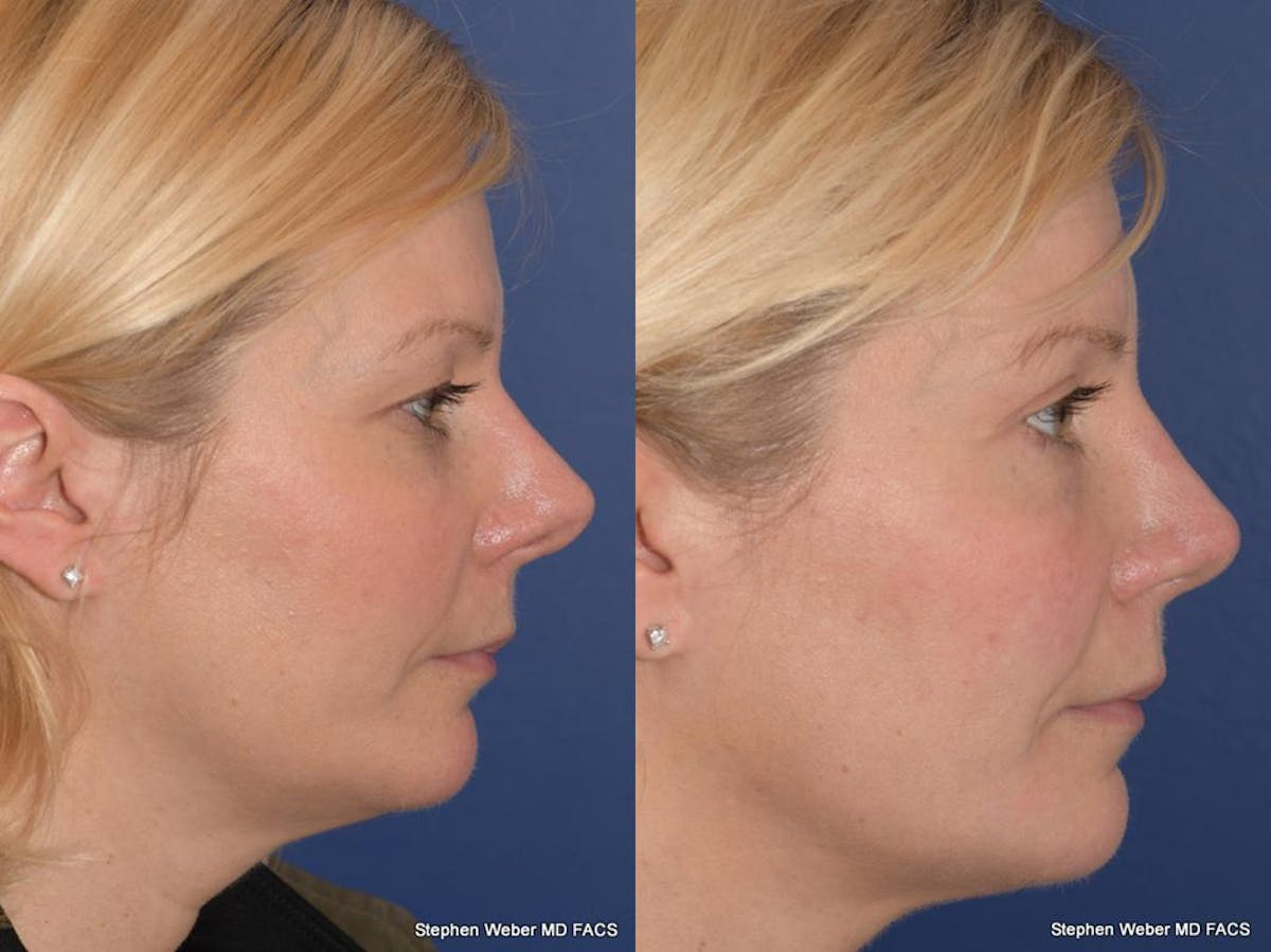 Blepharoplasty Before & After Gallery - Patient 185974 - Image 4