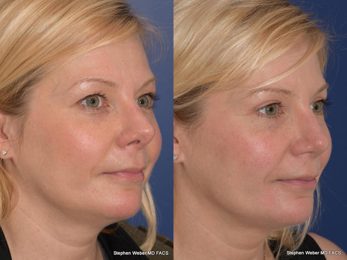 Blepharoplasty Before & After Gallery - Patient 185974 - Image 5