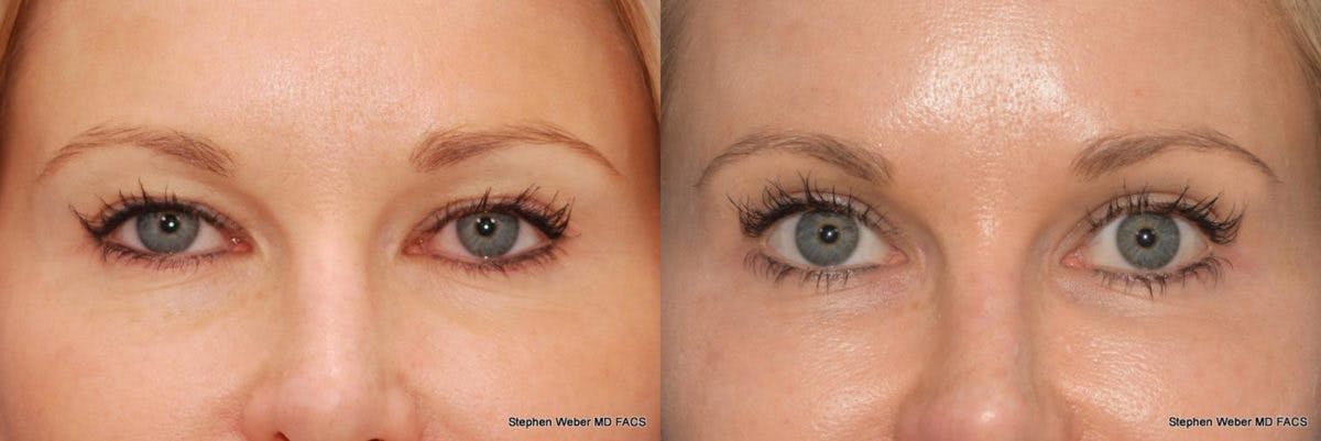 Blepharoplasty Before & After Gallery - Patient 509265 - Image 1