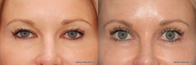 Blepharoplasty Before & After Gallery - Patient 509265 - Image 1