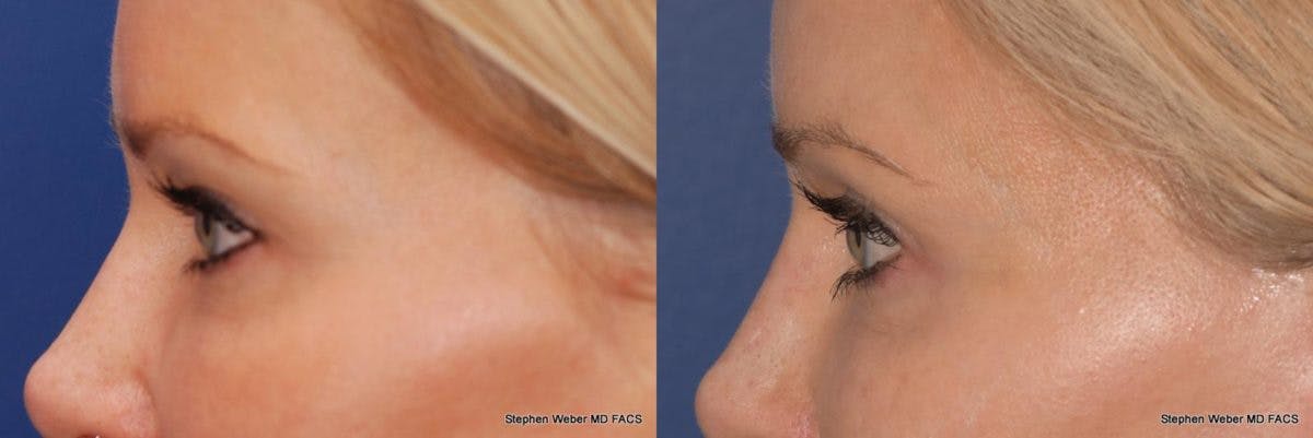 Blepharoplasty Before & After Gallery - Patient 509265 - Image 2