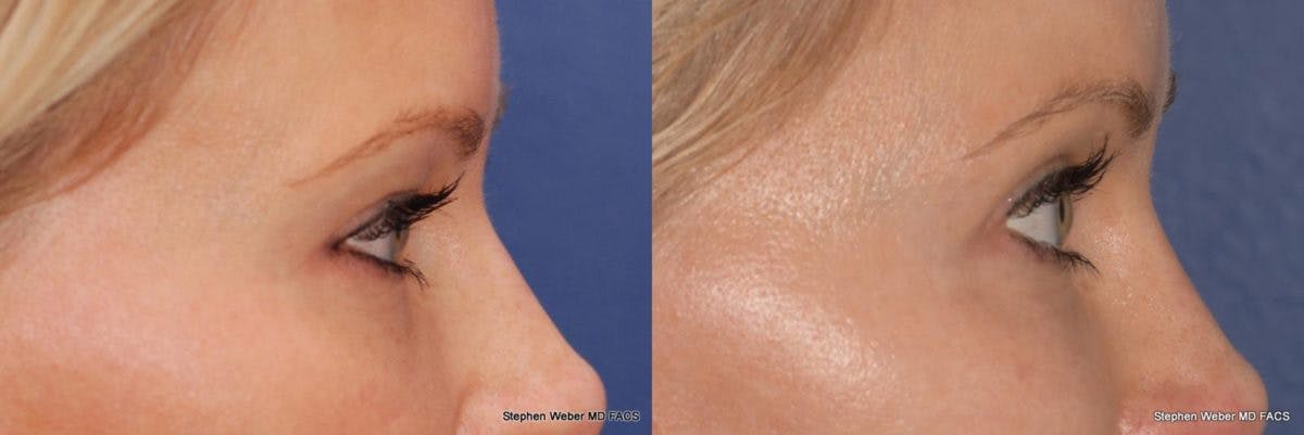 Blepharoplasty Before & After Gallery - Patient 509265 - Image 3
