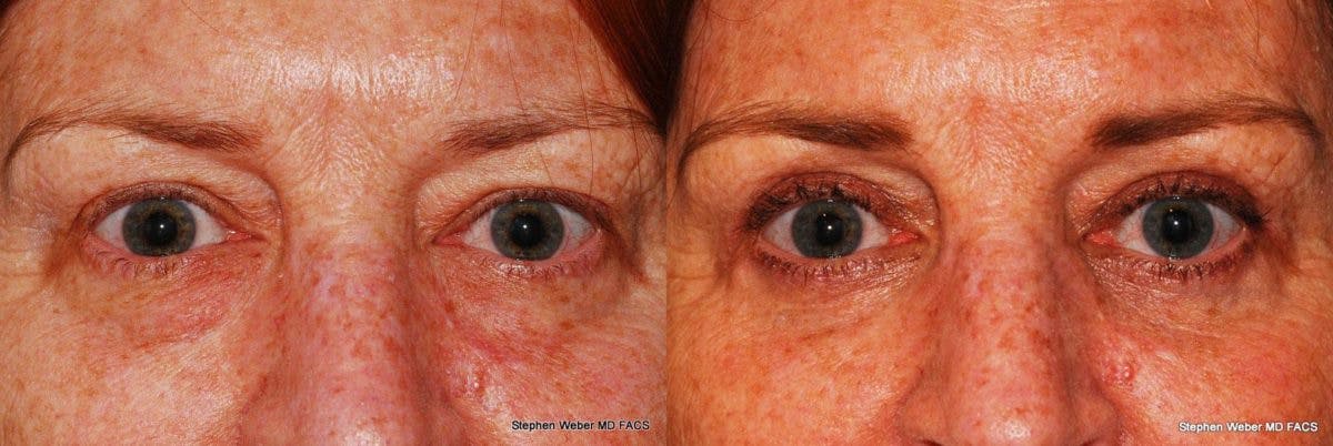 Blepharoplasty Before & After Gallery - Patient 127563 - Image 1