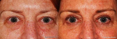 Blepharoplasty Before & After Gallery - Patient 127563 - Image 1