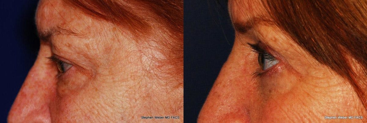 Blepharoplasty Before & After Gallery - Patient 127563 - Image 2