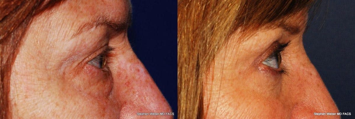 Blepharoplasty Before & After Gallery - Patient 127563 - Image 3