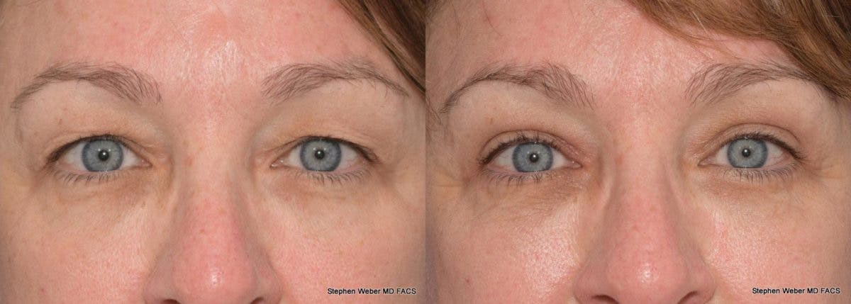 Blepharoplasty Before & After Gallery - Patient 299772 - Image 1