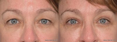 Blepharoplasty Before & After Gallery - Patient 299772 - Image 1