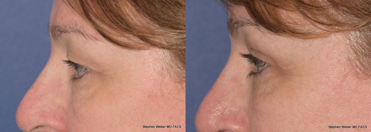 Blepharoplasty Before & After Gallery - Patient 299772 - Image 2