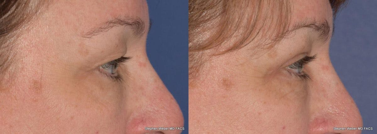 Blepharoplasty Before & After Gallery - Patient 299772 - Image 3