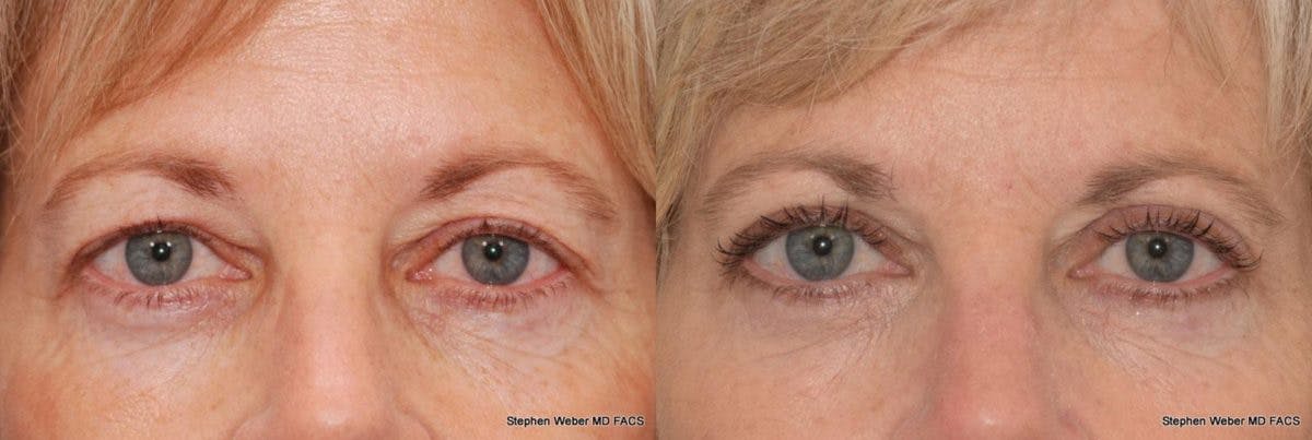 Blepharoplasty Before & After Gallery - Patient 303264 - Image 1