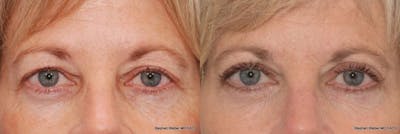 Blepharoplasty Before & After Gallery - Patient 303264 - Image 1