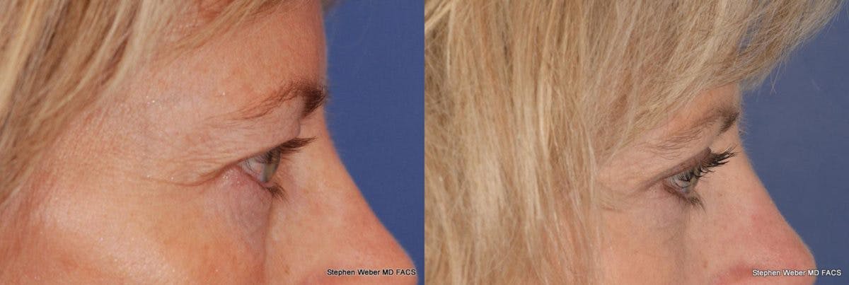 Blepharoplasty Before & After Gallery - Patient 303264 - Image 2