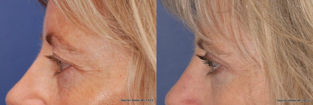 Blepharoplasty Before & After Gallery - Patient 303264 - Image 3