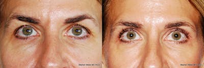 Blepharoplasty Before & After Gallery - Patient 149490 - Image 1