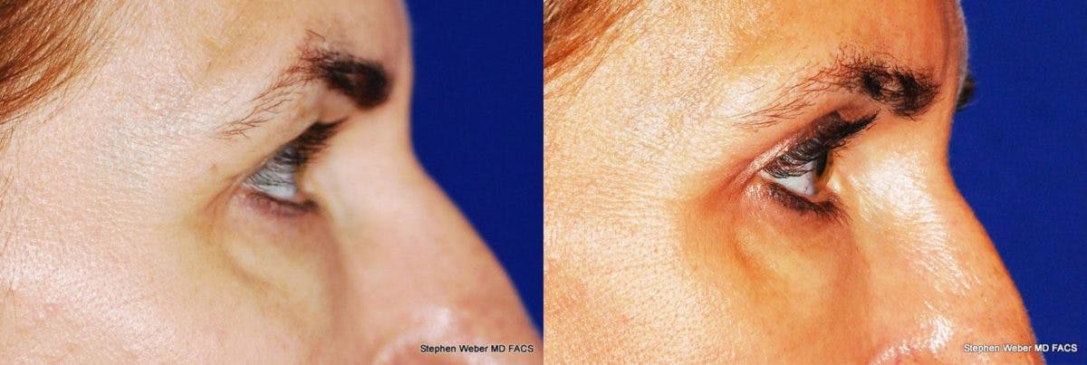 Blepharoplasty Before & After Gallery - Patient 149490 - Image 2