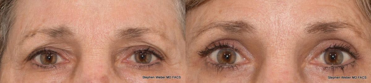 Blepharoplasty Before & After Gallery - Patient 428819 - Image 1