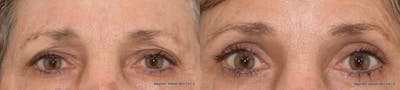 Blepharoplasty Before & After Gallery - Patient 428819 - Image 1