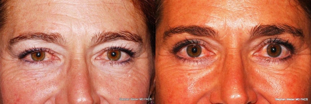 Blepharoplasty Before & After Gallery - Patient 253729 - Image 1