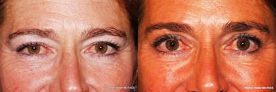 Blepharoplasty Before & After Gallery - Patient 253729 - Image 1