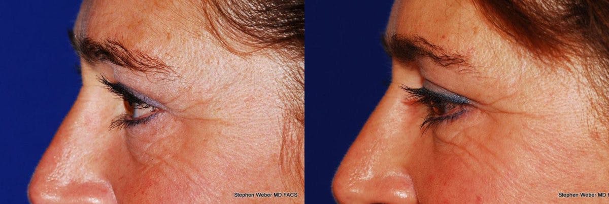 Blepharoplasty Before & After Gallery - Patient 253729 - Image 2