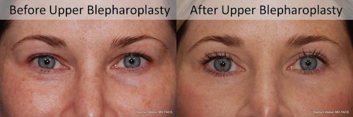 Blepharoplasty Before & After Gallery - Patient 207873 - Image 1