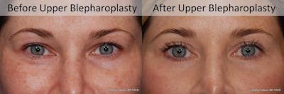 Blepharoplasty Before & After Gallery - Patient 207873 - Image 1