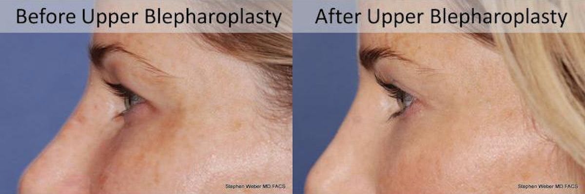 Blepharoplasty Before & After Gallery - Patient 207873 - Image 2