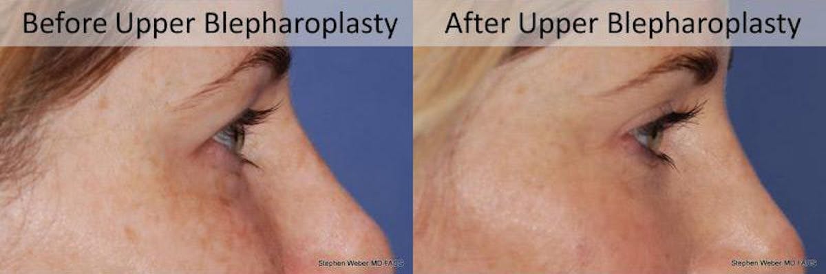 Blepharoplasty Before & After Gallery - Patient 207873 - Image 3