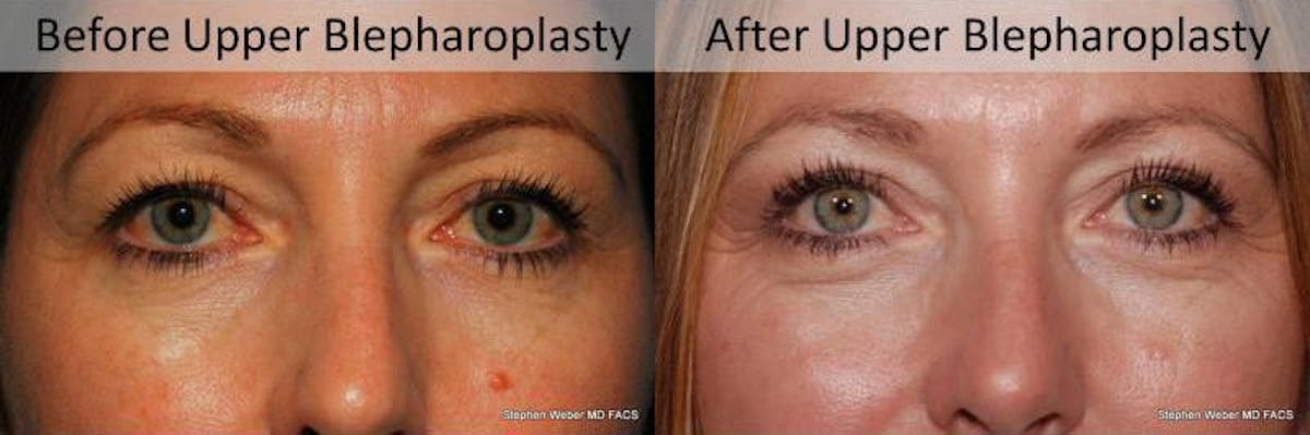 Blepharoplasty Before & After Gallery - Patient 130097 - Image 1