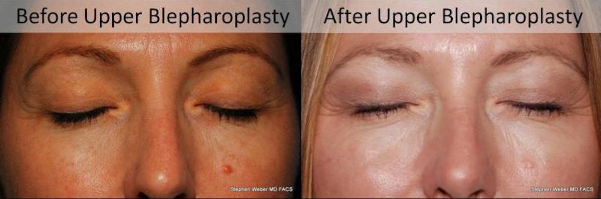 Blepharoplasty Before & After Gallery - Patient 130097 - Image 2