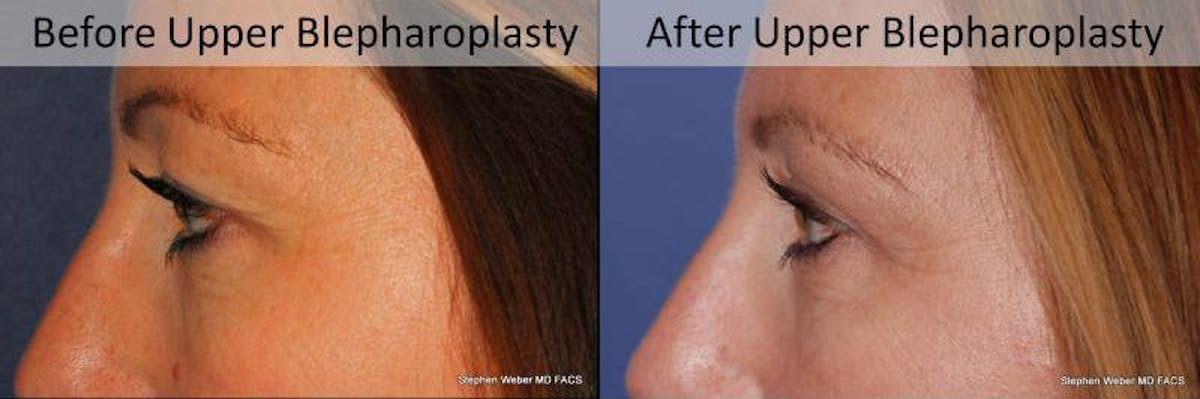Blepharoplasty Before & After Gallery - Patient 130097 - Image 3