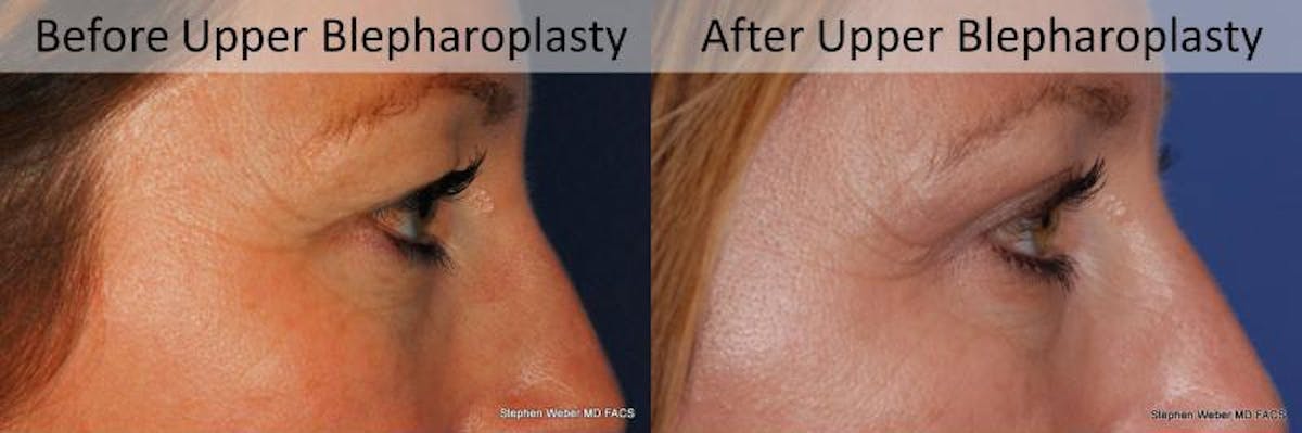 Blepharoplasty Before & After Gallery - Patient 130097 - Image 4