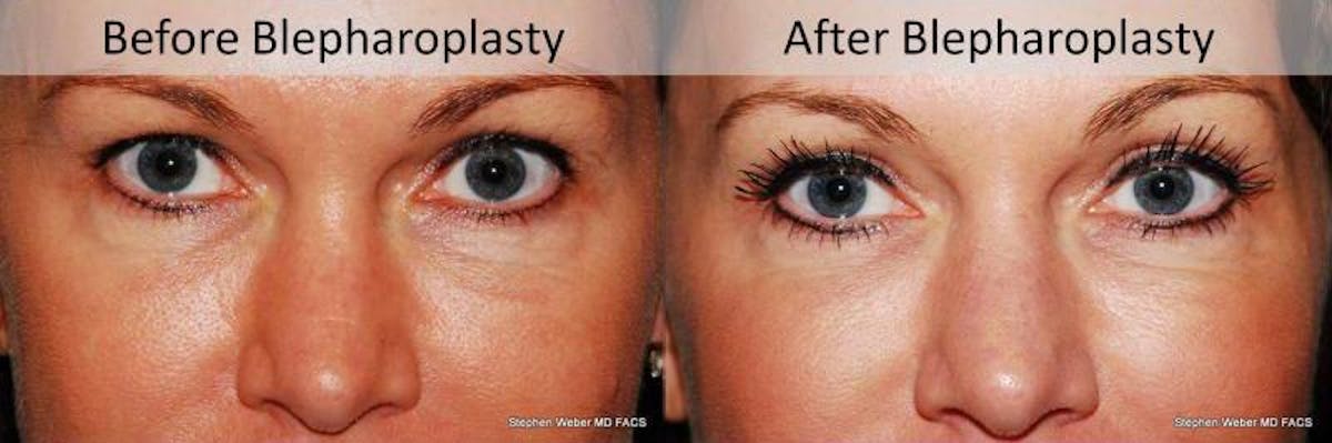 Blepharoplasty Before & After Gallery - Patient 399722 - Image 1