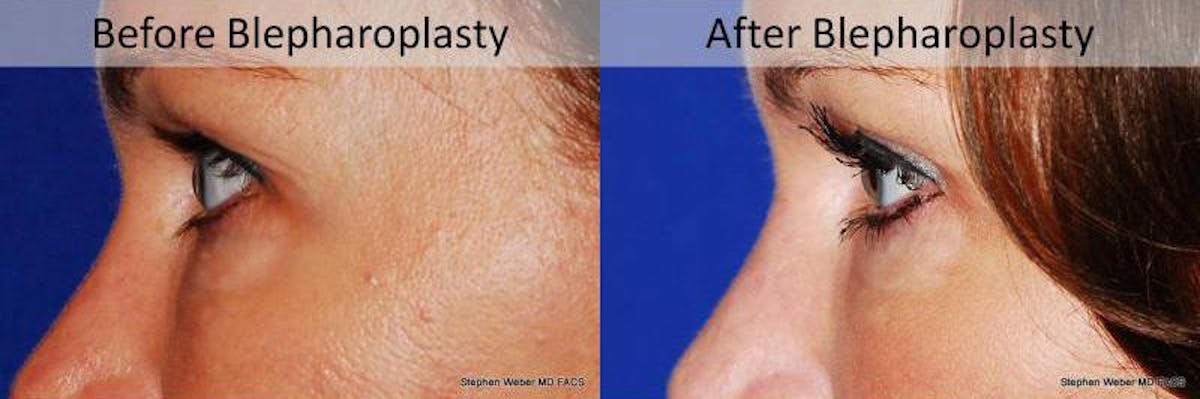 Blepharoplasty Before & After Gallery - Patient 399722 - Image 2