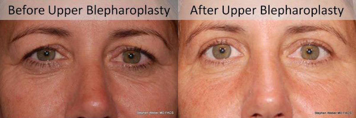 Blepharoplasty Before & After Gallery - Patient 234840 - Image 1