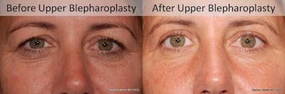 Blepharoplasty Before & After Gallery - Patient 234840 - Image 1