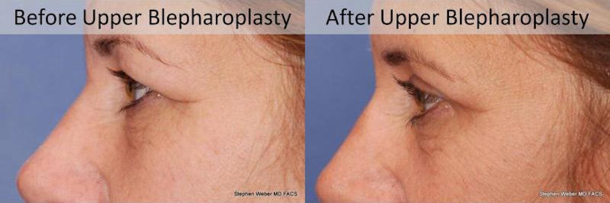 Blepharoplasty Before & After Gallery - Patient 234840 - Image 2