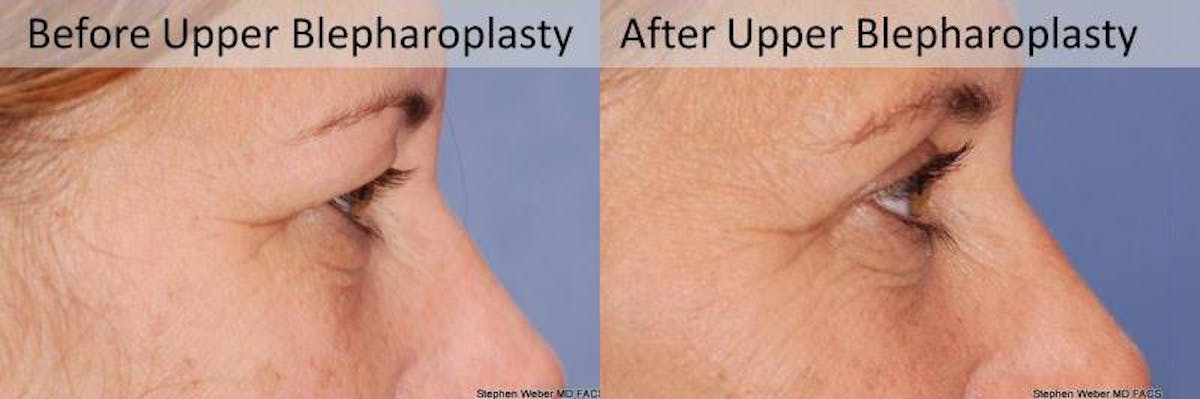 Blepharoplasty Before & After Gallery - Patient 234840 - Image 3