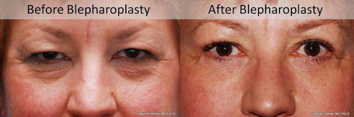 Blepharoplasty Before & After Gallery - Patient 772580 - Image 1