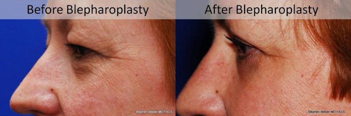 Blepharoplasty Before & After Gallery - Patient 772580 - Image 2