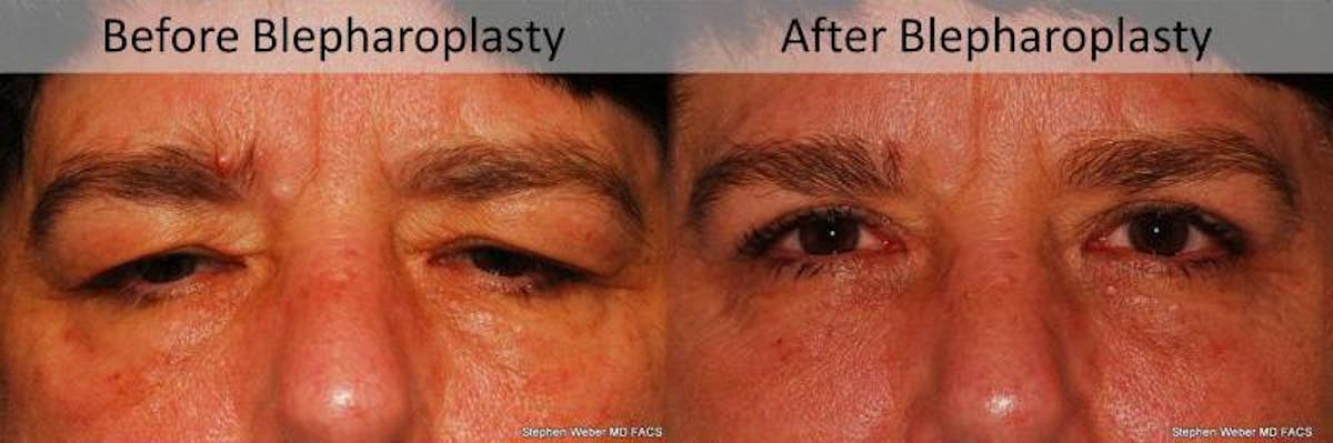 Blepharoplasty Before & After Gallery - Patient 426513 - Image 1
