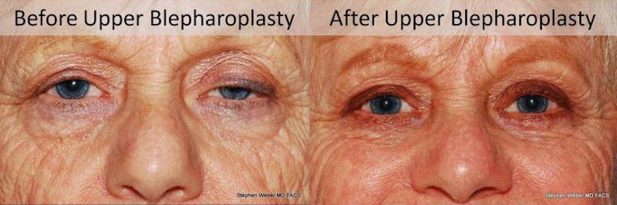 Blepharoplasty Before & After Gallery - Patient 419854 - Image 1